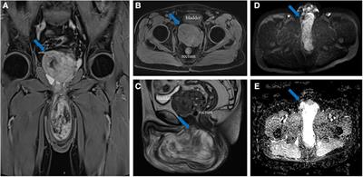 Case report and literature review: Rare male aggressive angiomyxoma of the scrotum